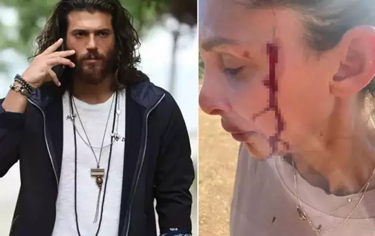 Can Yaman'ın sevgilisi Sara Bluma şiddet gördüğünü açıkladı