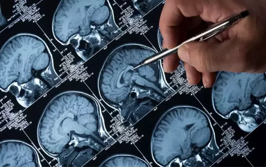 Lityum Alzheimer'ın İlerlemesini Etkileyebilir