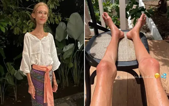 Meyve diyetiyle 20 kiloya kadar düşen sosyal medya fenomeni hayatını kaybetti