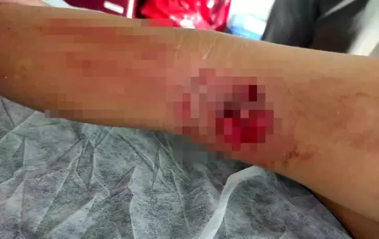 Köpek Saldırısı: 8 Yaşındaki Çocuk Yaralandı