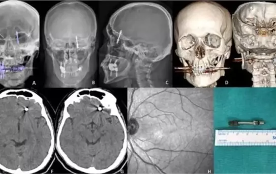 Diş İmplantı Kabusa Dönüştü