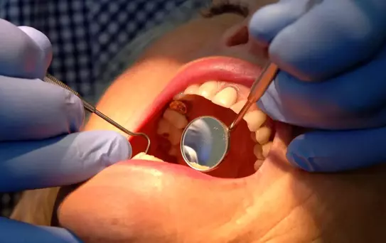 Diş Minesi İçin Yenilikçi Jel Geliştirildi