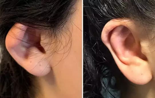 Kepçe Kulak Ameliyatı Özgüveni Artırıyor