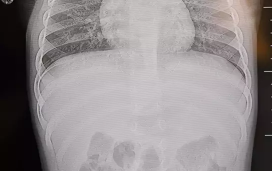 1 yaşındaki bebek sırtüstü yatırılınca hep ağladı! Gerçeği öğrenen aile şoke oldu