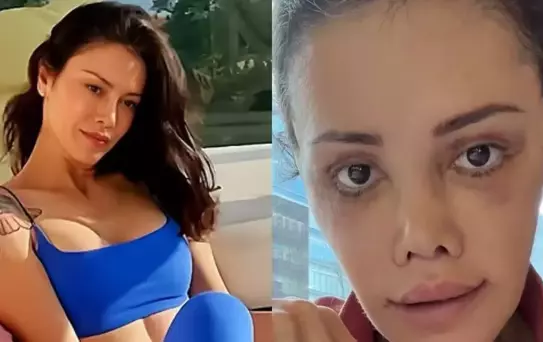 Yüz nakli yaptıran Didem Ceran'ın son hali: Harika gözüküyorum