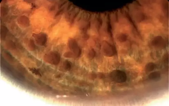 Nörofibromatozis Tip 1 Tanısı OCT ile Daha Kolay ve Başarılı