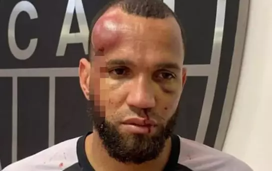 23 kırmızı kartın çıktığı futbol savaşında kaleci tanınmayacak hale geldi