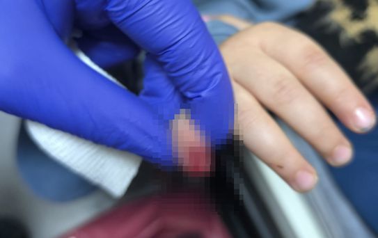 AVM'de yürüyen merdivene eli sıkışan çocuğun parmağı koptu