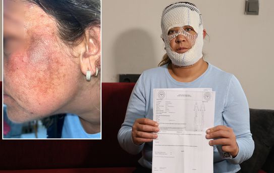 Prenses cilt bakımı yüzünü yaktı: Oğlum 'öcü' deyip benden kaçıyor