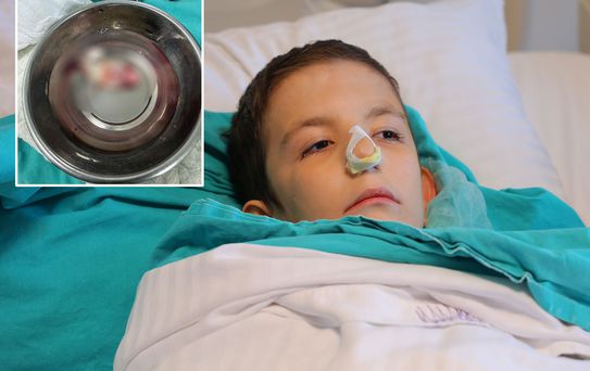 Burun tıkanıklığı şikayetiyle hastaneye gitti, ağzından dev bir polip çıkartıldı