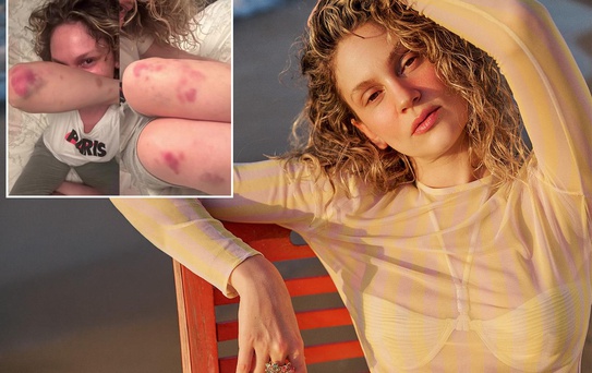Farah Zeynep Abdullah'ın vücudundaki morluklar korkuttu