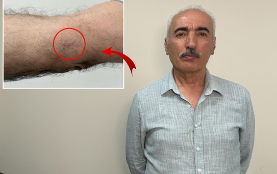 Kolundaki 1 santimetrelik yara kanser çıktı