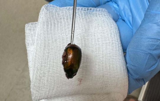 Kulağındaki ağrının nedeni şaşkına çevirdi! Doktorlar Japon böceği çıkardı