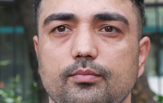 Burun ameliyatına girdi, başına gelmeyen kalmadı! İşini bile kaybetti