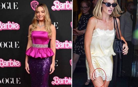 Barbie yıldızı Margot Robbie'nin bacağındaki morluk hayranlarını endişelendirdi