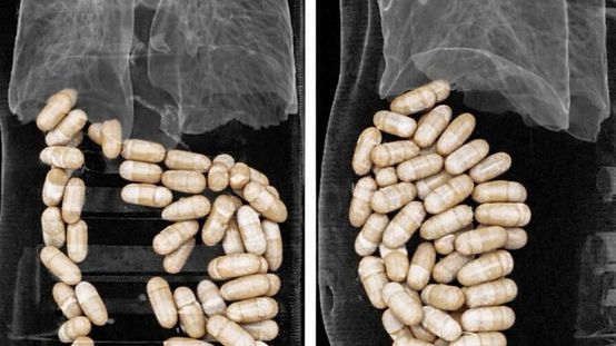 İzmirde 2 şüphelinin midesinden 1 kilo 304 gram uyuşturucu çıktı