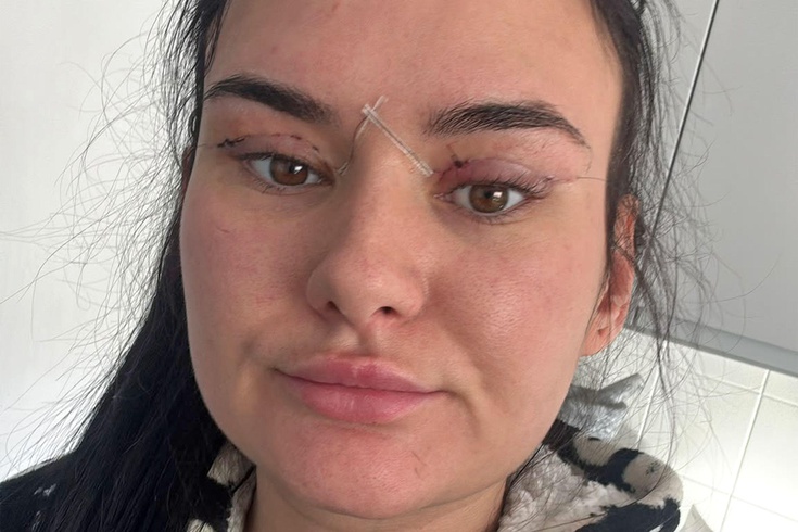 Göz kapağı ameliyatı için yurt dışına gittiler, acil servise düştüler