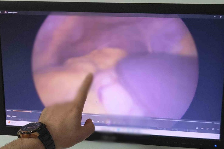 Kalbi sağda olan inşaat işçisinin diğer organları da ters çıktı: Samsun'da zorlu ameliyat