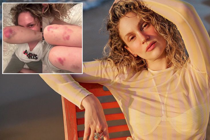 Farah Zeynep Abdullah’ın vücudundaki morluklar korkuttu