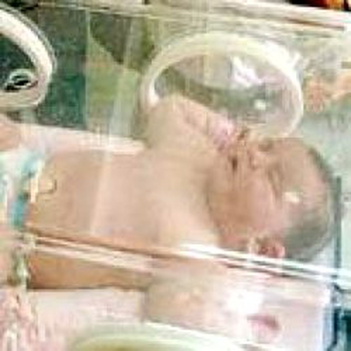 'Tosun Bebek' Merve, Beş Gün Yaşayabildi