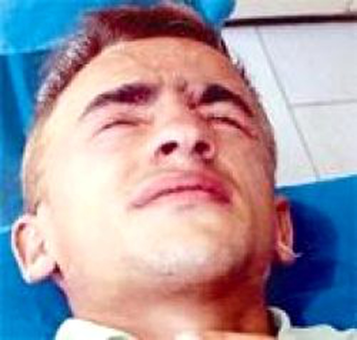 Yapıştırıcı Sıçradı Göz Kapakları Yapıştı
