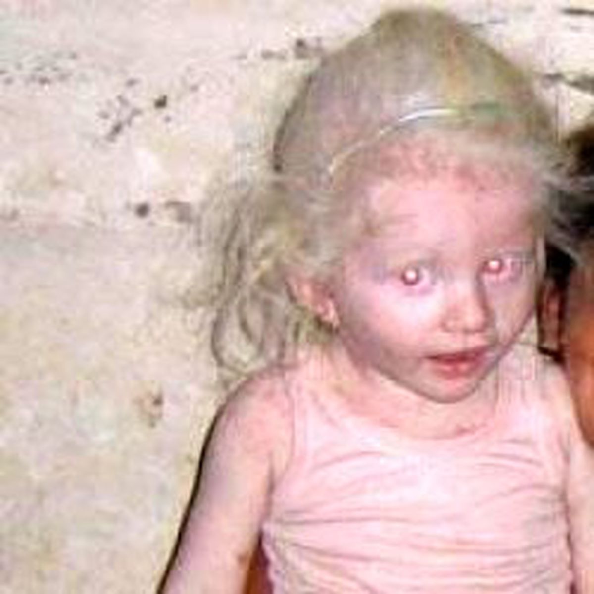 Albino Kızın Kol ve Bacaklarını Kopardılar