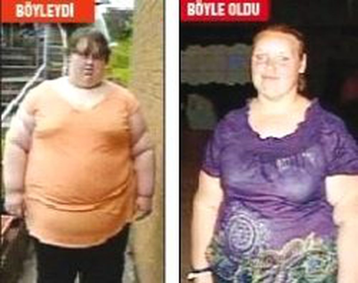 En Şişman Kız 95 Kg Zayıfladı