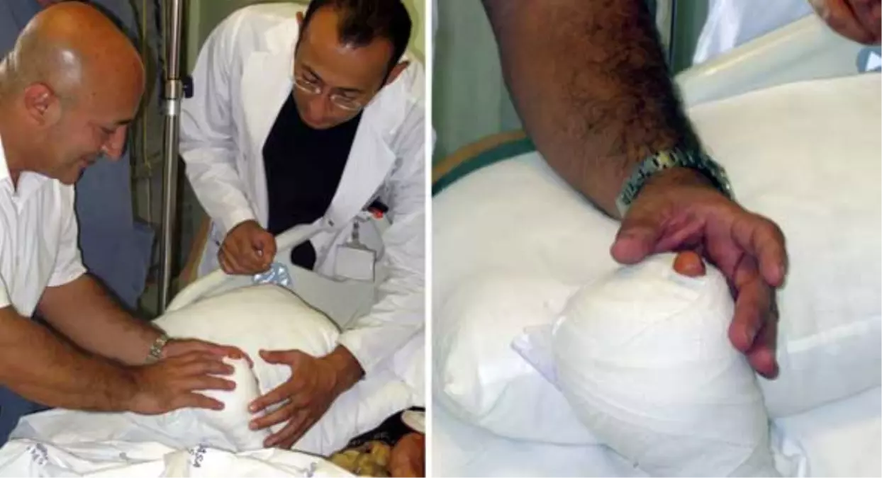 Ayak Parmaklarını Eline Diktiriyor