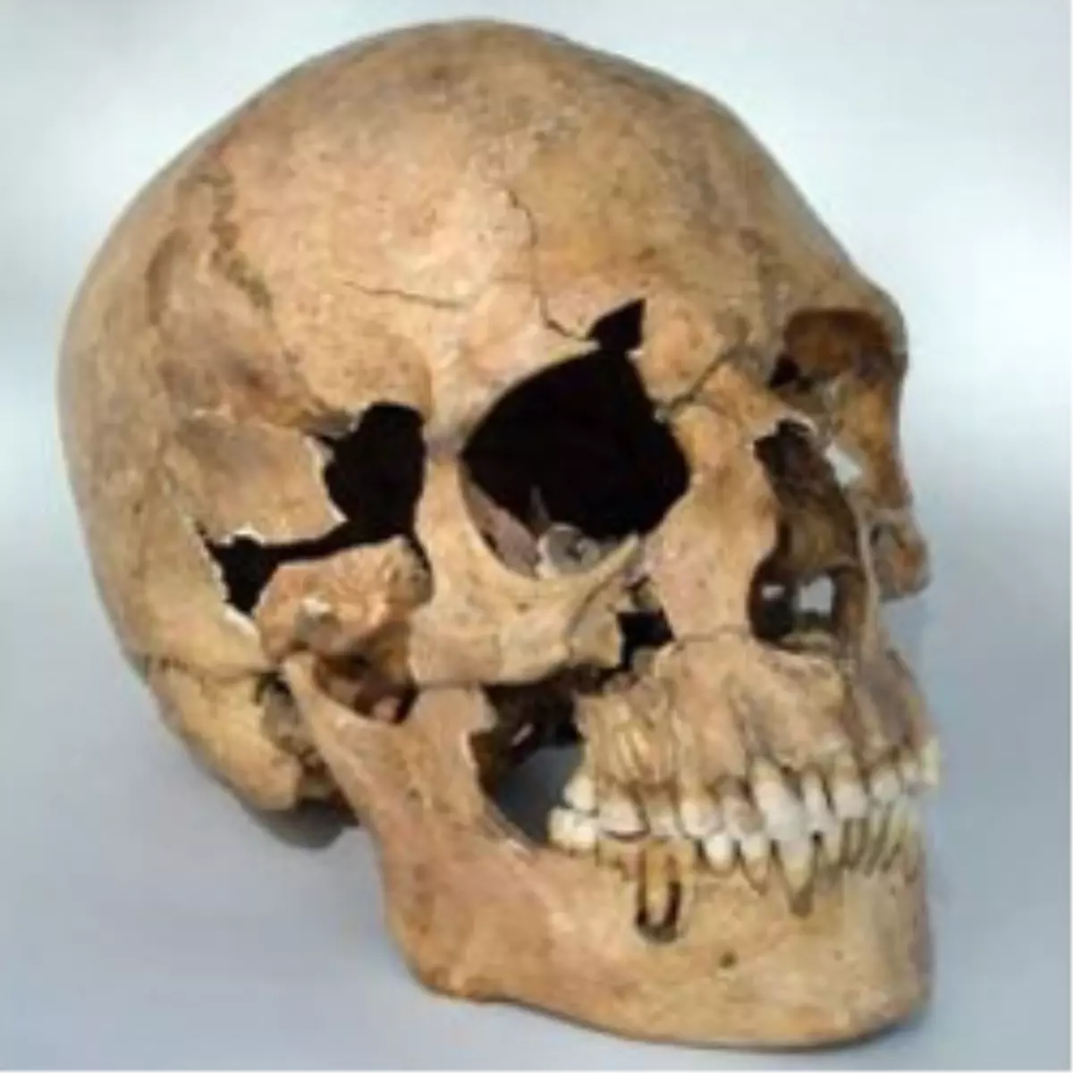 1800 Yıllık Kafatasında Ameliyat İzi