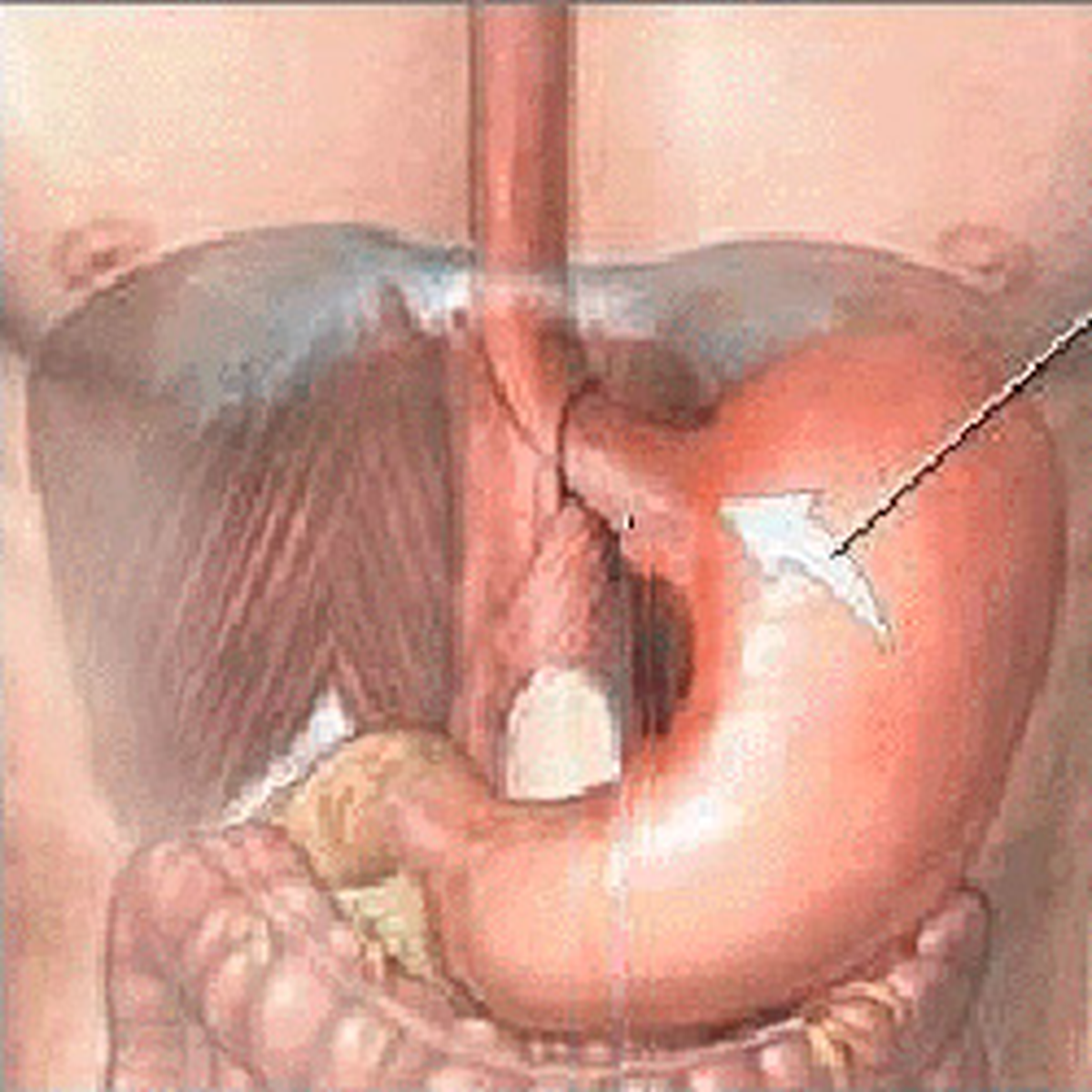 Gastroözofageal Reflüde TİF Tanısı ve Tedavisi