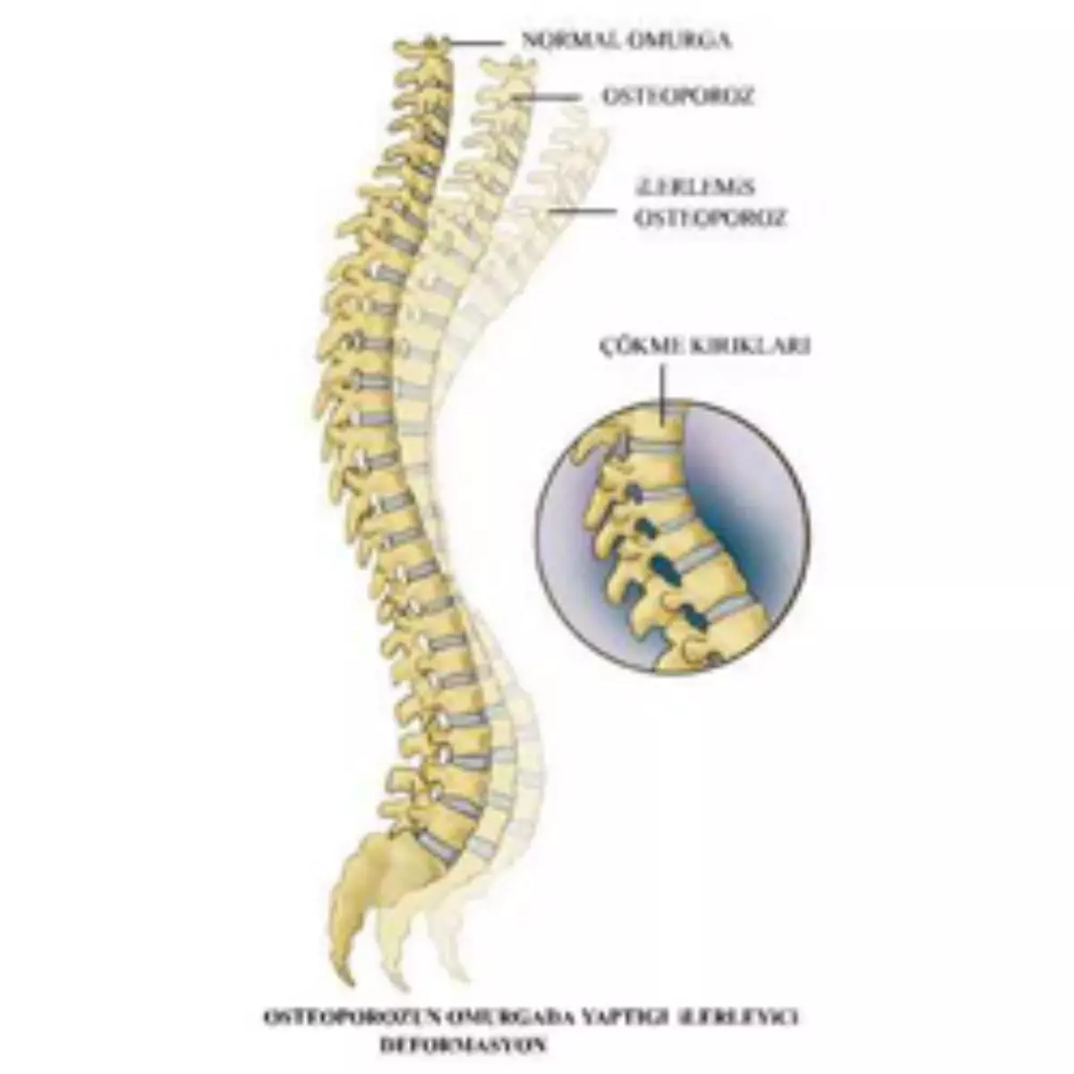 Osteoporoz Tanımı ve Tedavisi