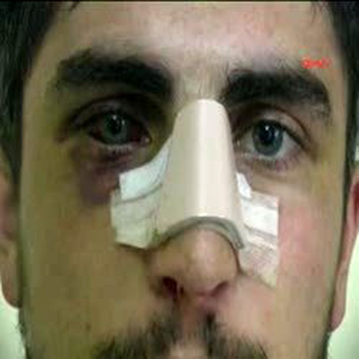 Dolmabahçe'de Polisin Müdahalesiyle Burnu Kırılan Öğrenci Taburcu Edildi