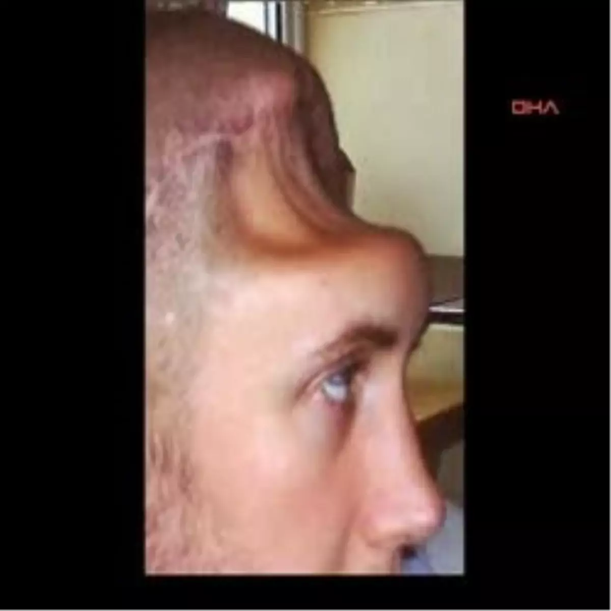 Titanyumdan Kafatası