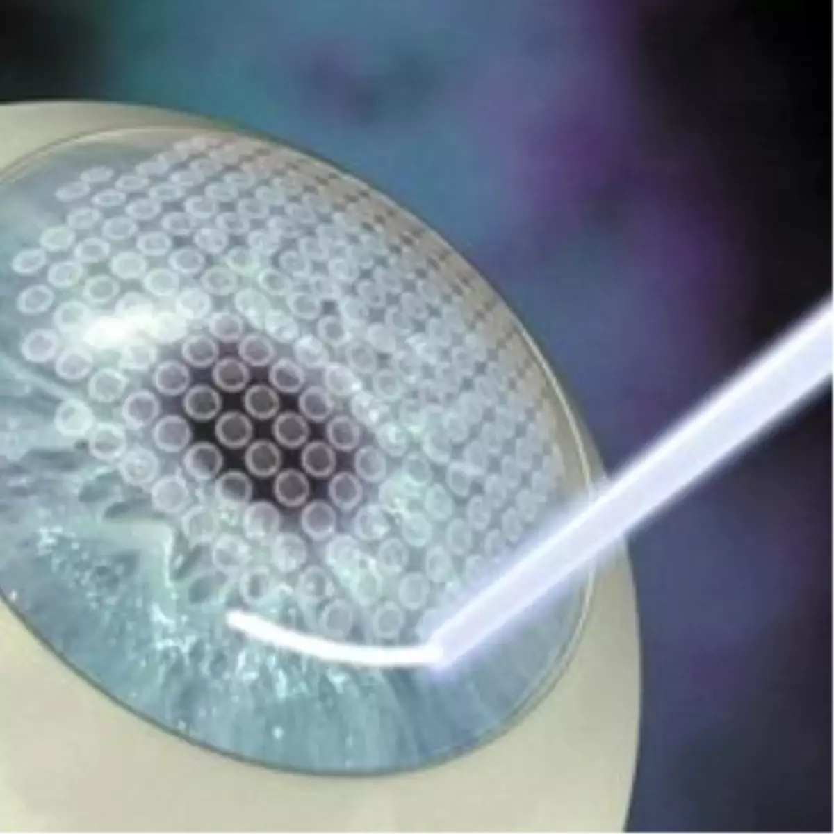 Göz Bozukluğu Tedavisinde İ-Lasık