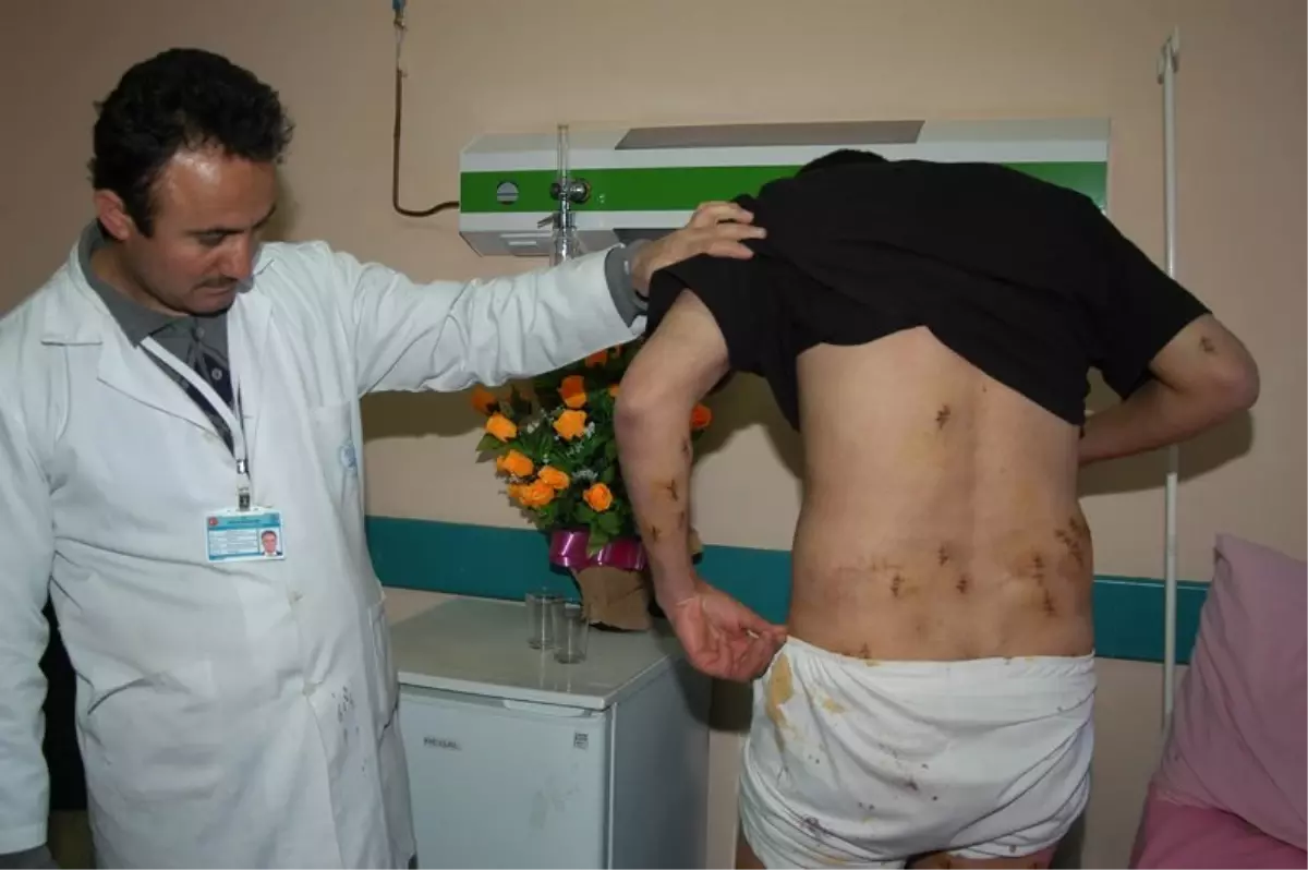 Vücudundan 134 Yağ Bezesi Çıkarıldı