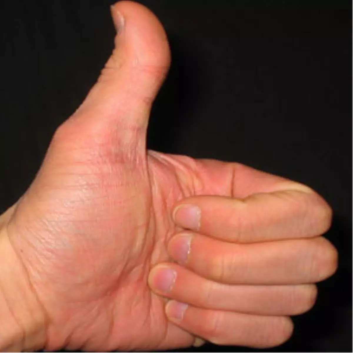 Başparmağının Yerine Ayak Parmağı