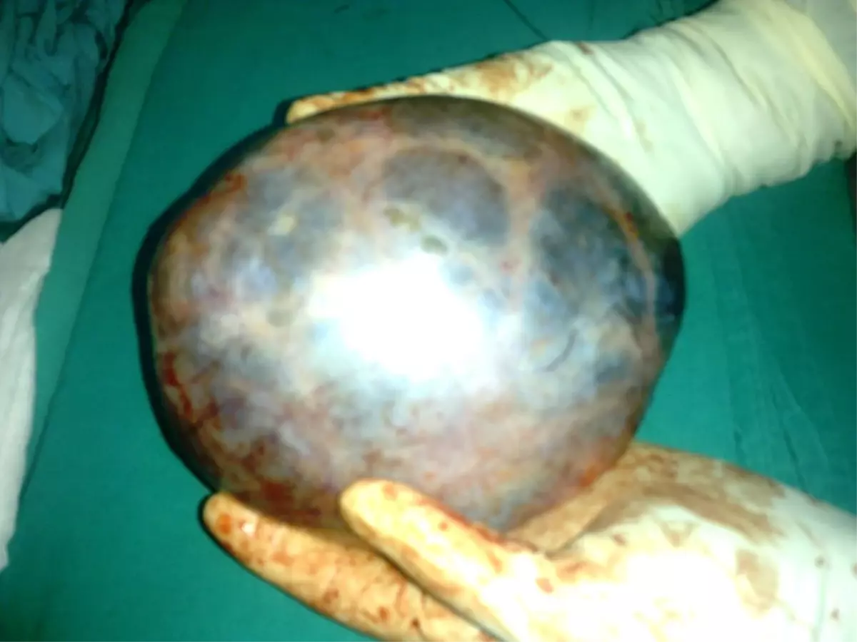 Yumurtalığından 1,5 Kilo Kist Çıktı