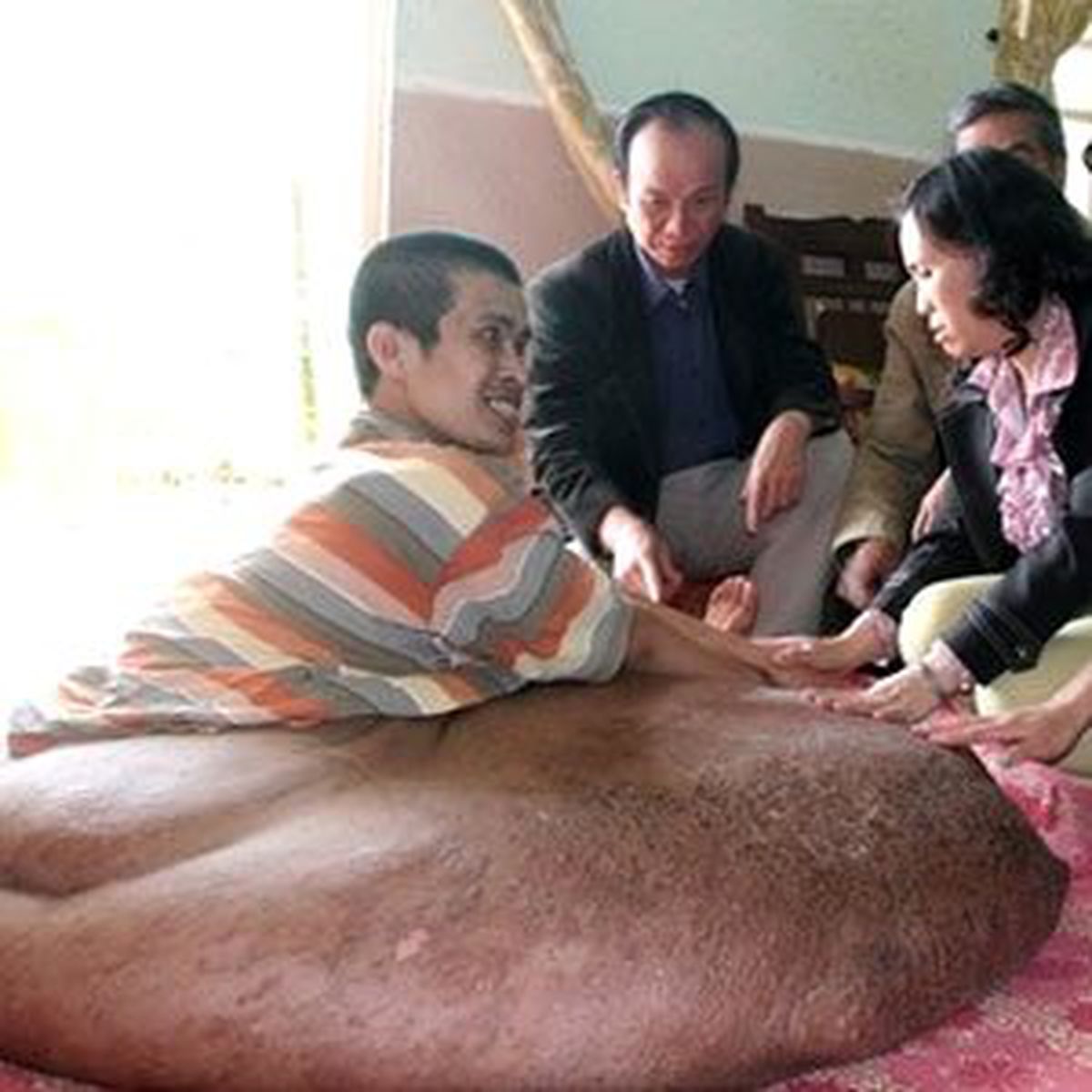 90 Kilogramlık Tümöre 10 Saat Ameliyat