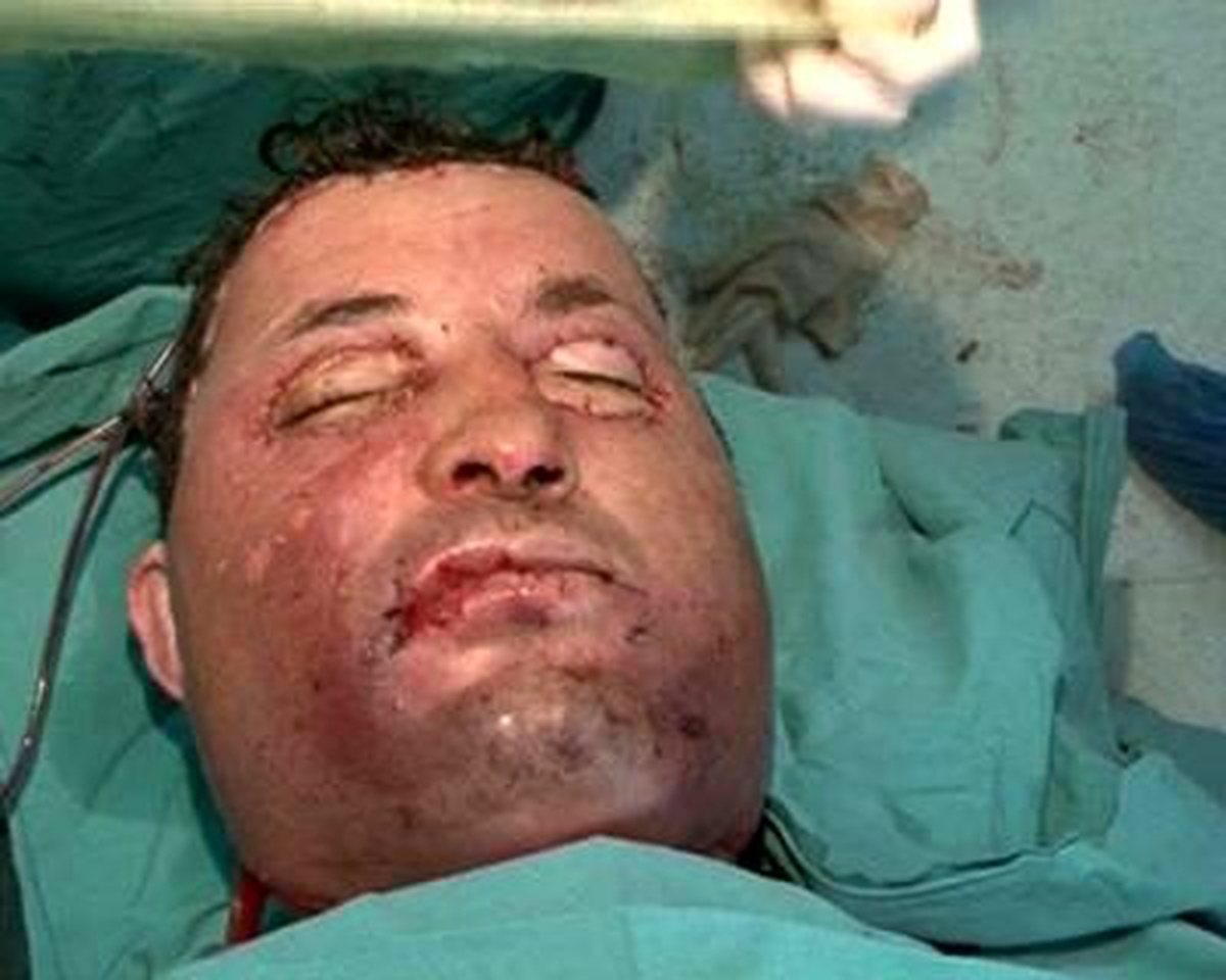 Yüz Naklini Yapan Profesör Özkan Birebir Benzemeyecek