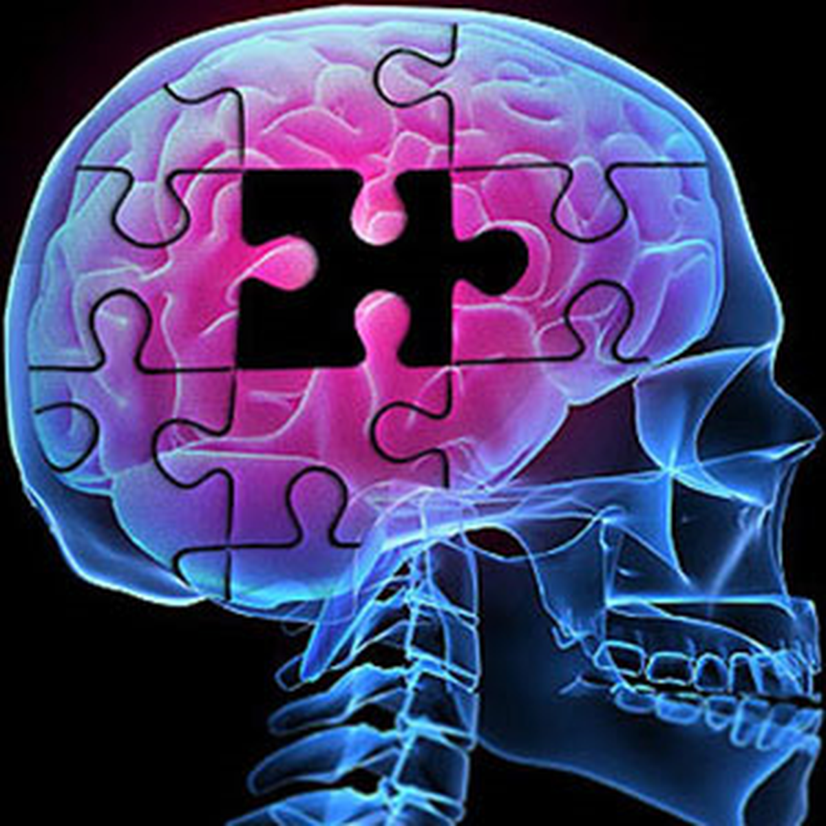 Alzheimer Beyinde Enfeksiyon Gibi Yayılıyor