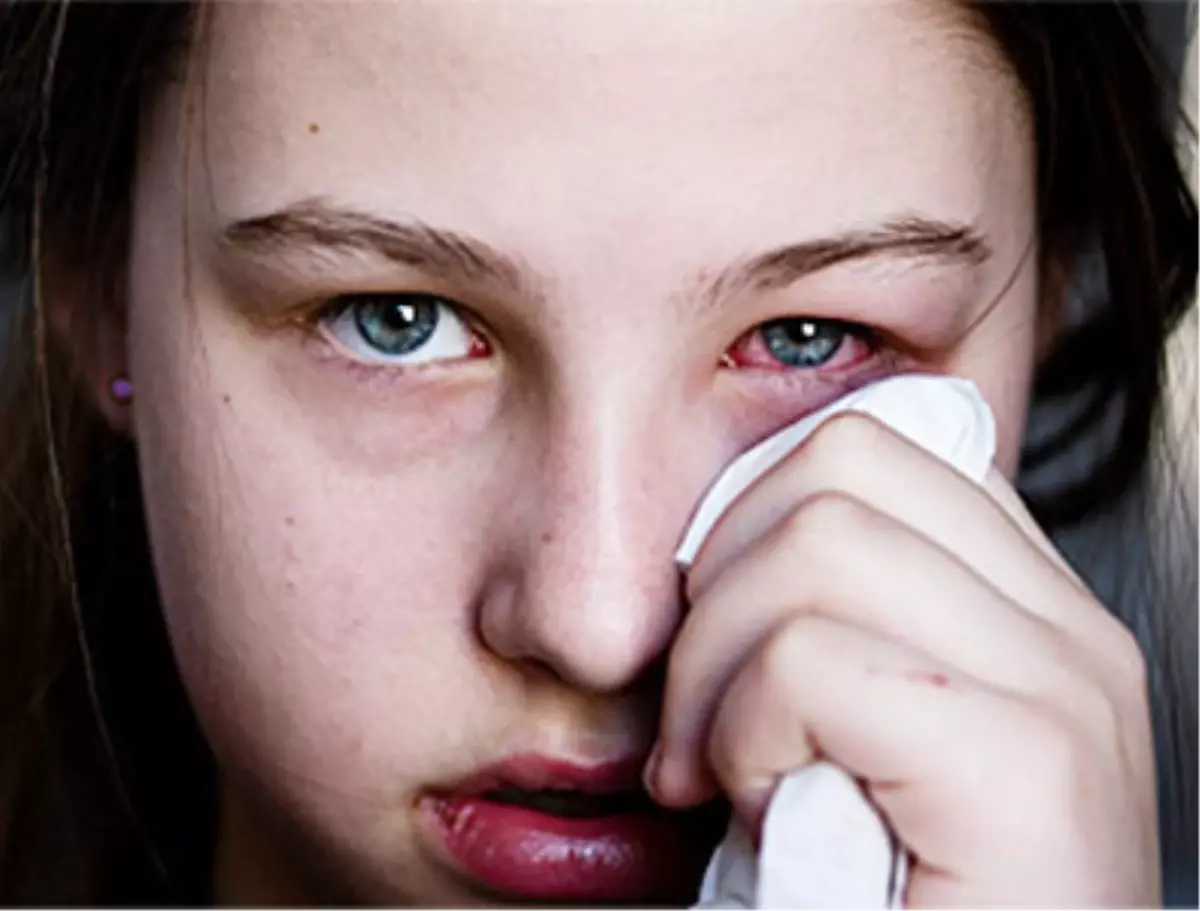 Göz Kanlanması Deyip Geçmeyin!