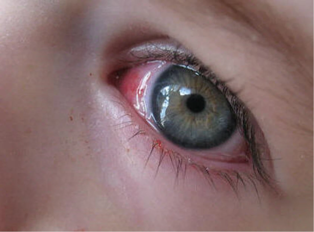 Gözlerin Sık Sık Kanlanması Hastalık Belirtisi Olabilir
