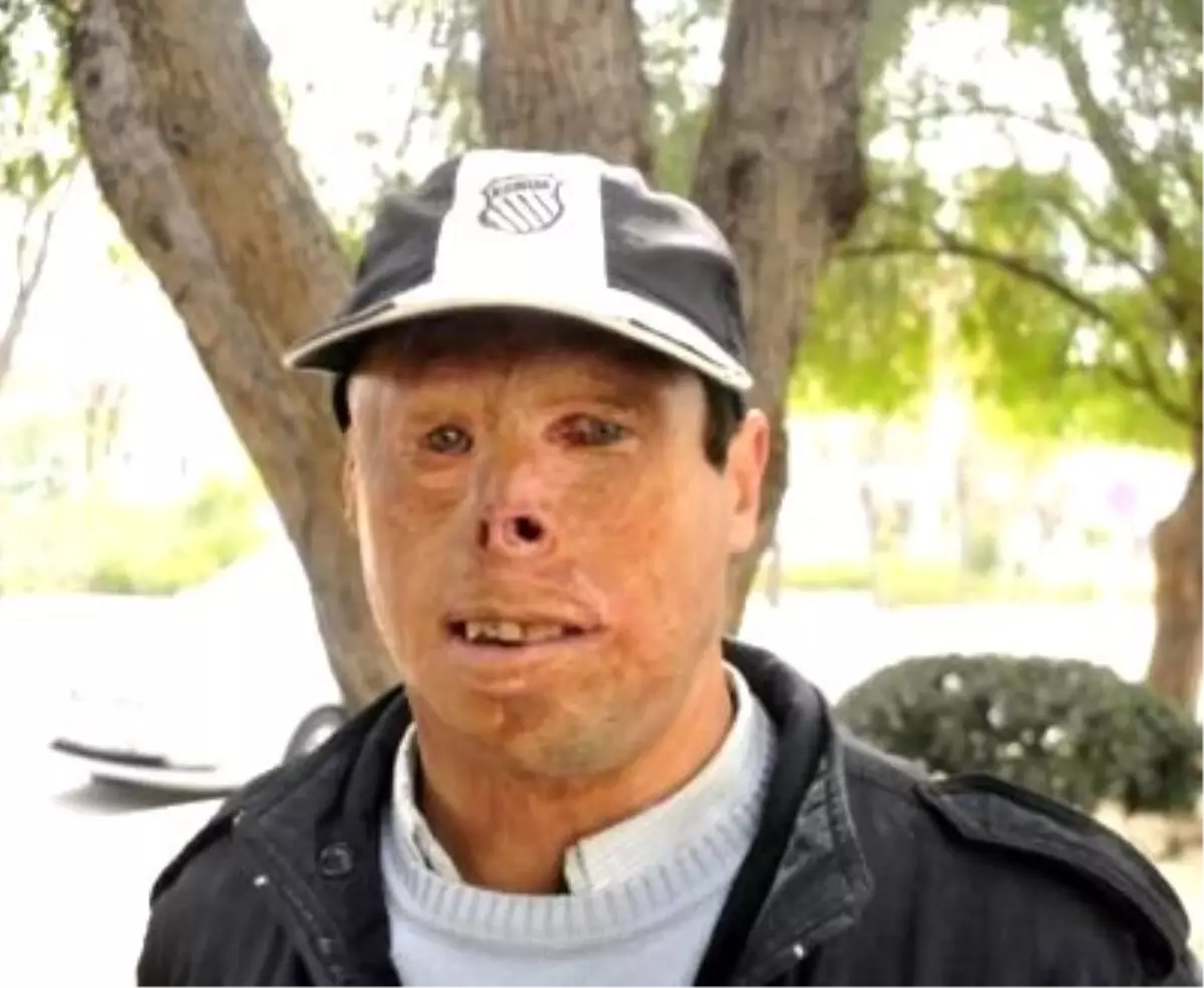 İkinci Yüz Nakli Ankara\'da Yapılacak