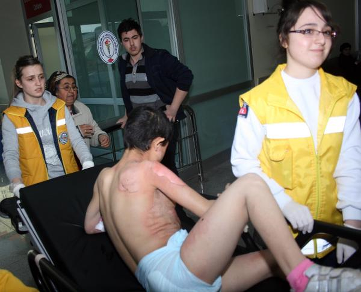 Zihinsel Engelli Genç Kız Kaynar Suda Haşlandı