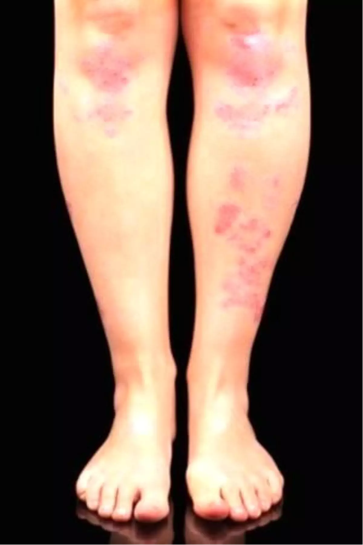 Sedef Hastalığına Bitkisel Kür