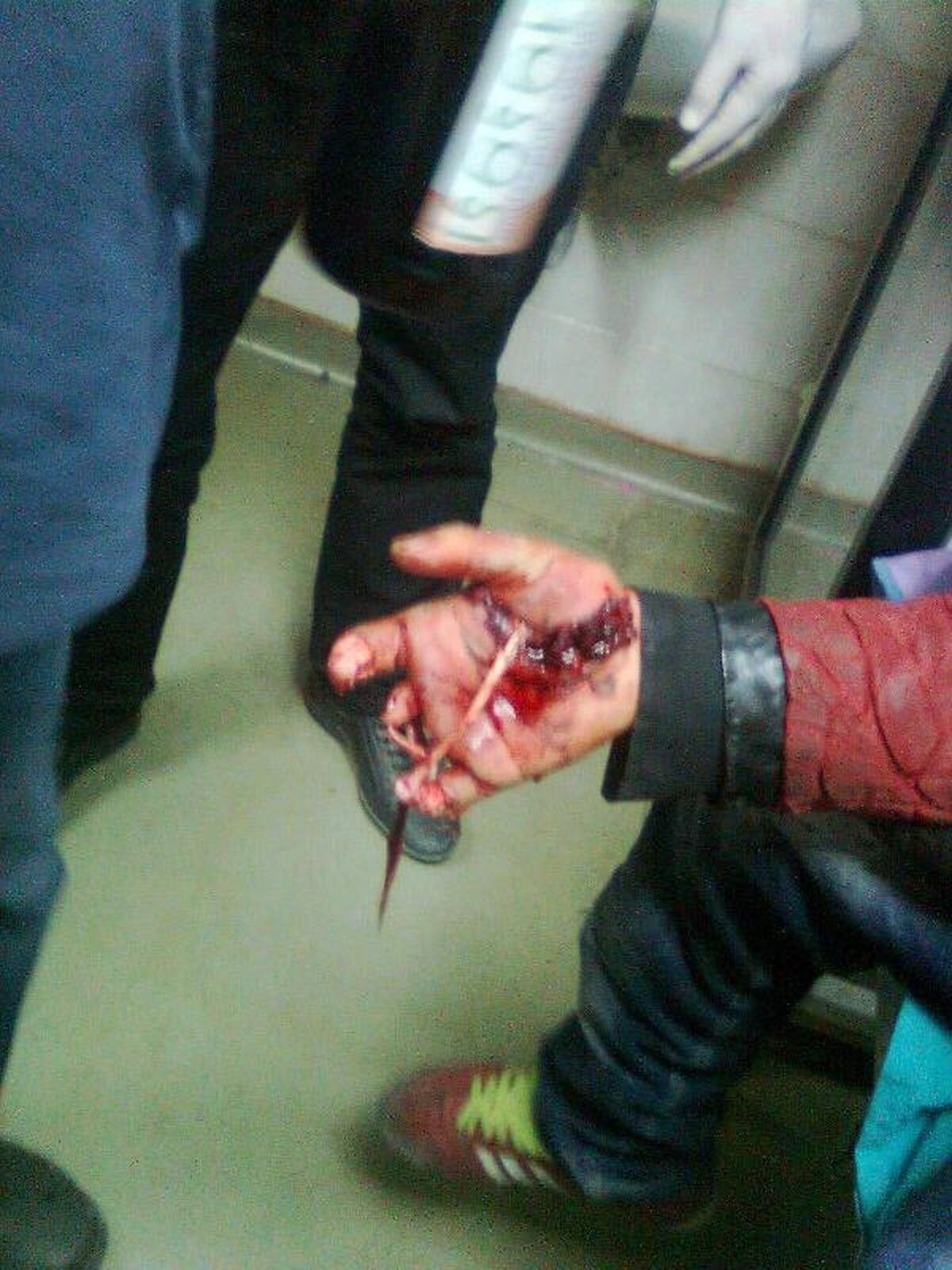Polise Atmak İstediği Bomba Elinde Patlayan Çocuğa 22 Yıl Hapis İstemi