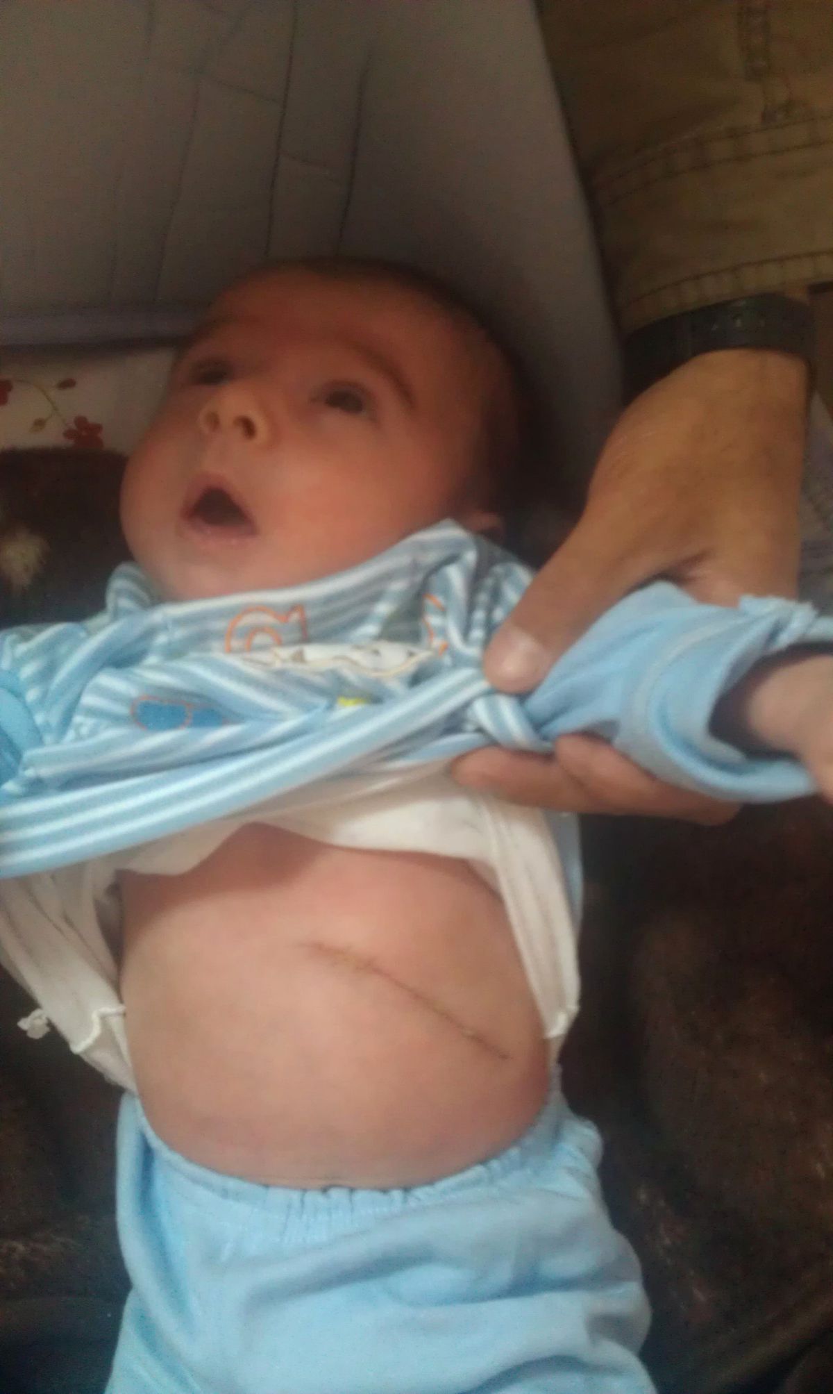 İç Organları Göğüs Kısmında Olan Bebek Başarılı Ameliyatla Hayata Döndürüldü