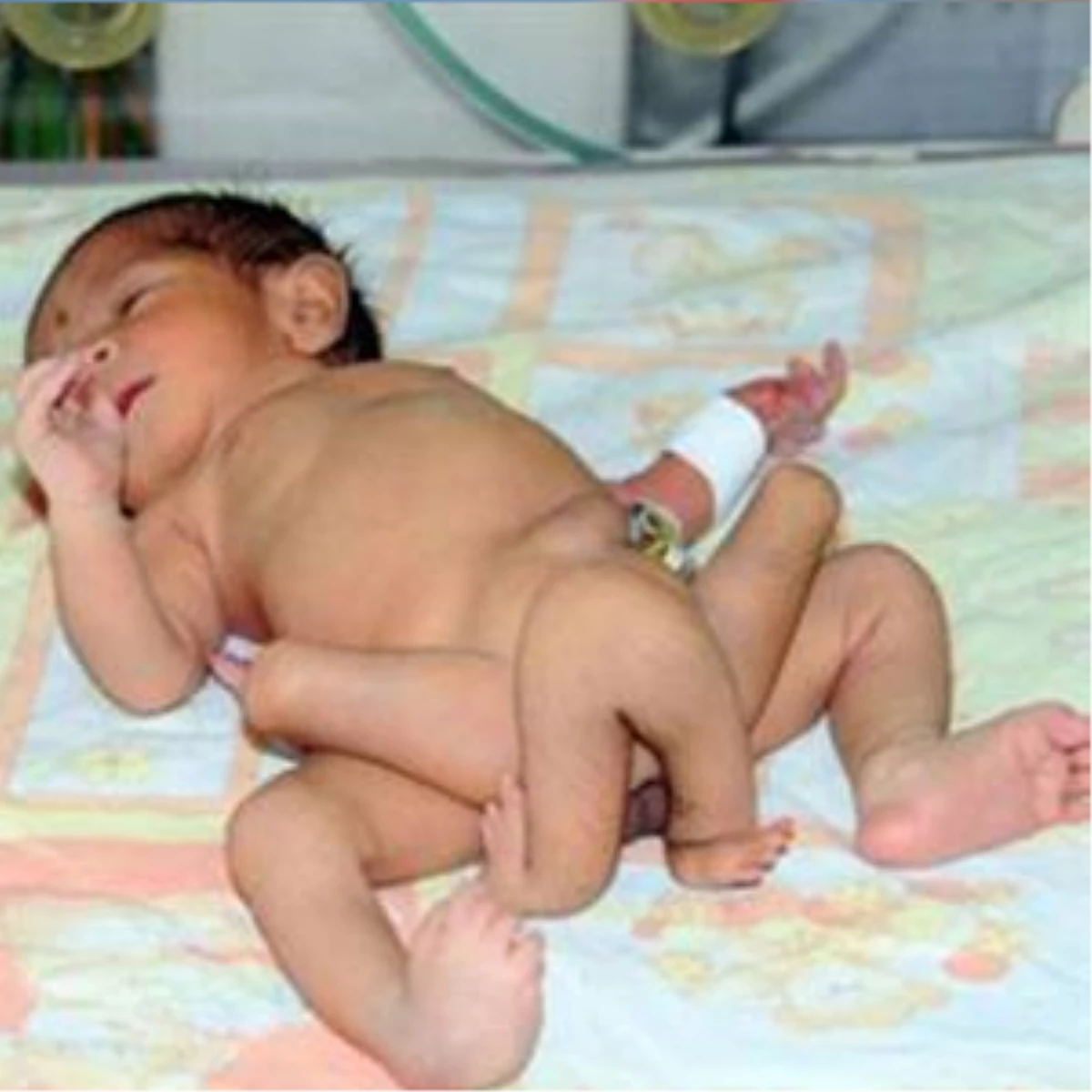 6 Bacaklı Bebek Dünyaya Geldi