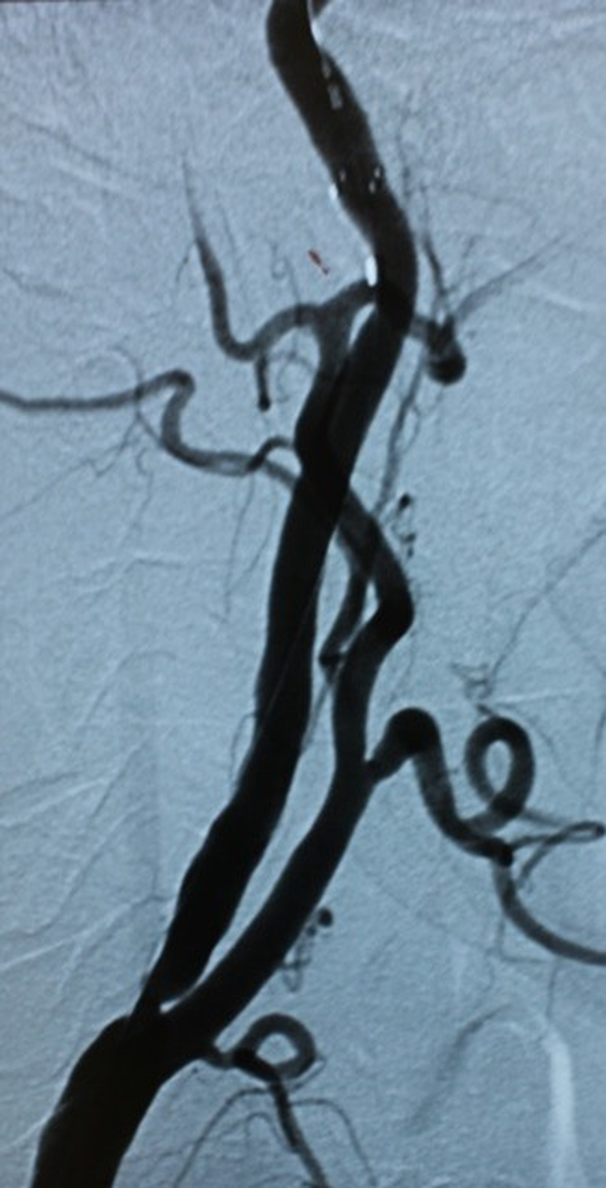 Şah Damarına Stent Uygulamaları