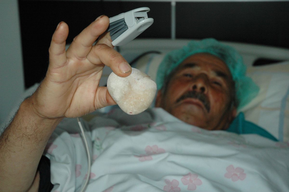 (Özel Haber) İdrar Torbasından 300 Gram Taş Çıktı